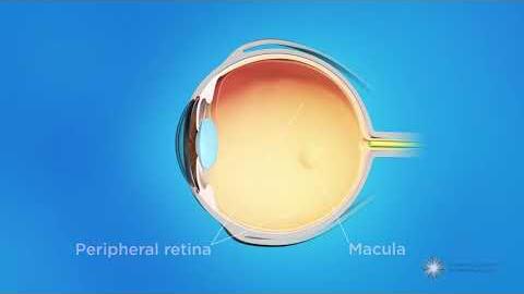 Retinopatia wcześniaków Retinopatia wcześniaków Zapobieganie retinopatii Systematyczna kontrola okulistyczna od ok. 3-4 tyg.