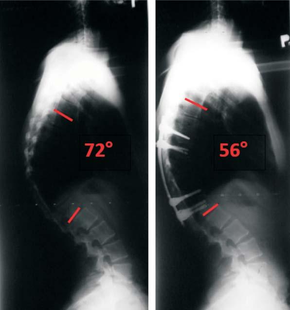 Kyphotic deformities as a result of laminectomy results of surgical treatment 67 METHODS Following data was evaluated: age at initial surgery, type of resected pathology, location of the pathology,