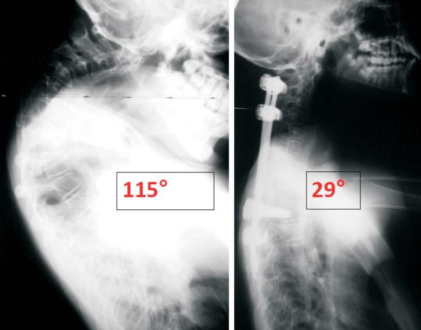 Kyphotic deformities as a result of laminectomy results of surgical treatment 69 screws or hooks were inserted at least two levels cranially and caudally to the apex of deformity.