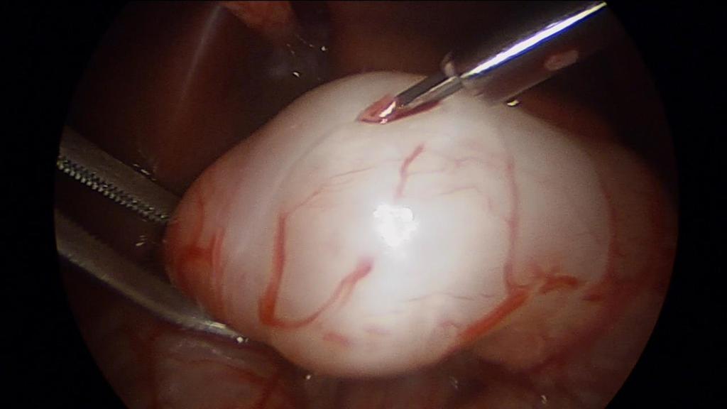 Przerostowe zwężenie odźwiernika: prospektywne badanie laparoskopia v.