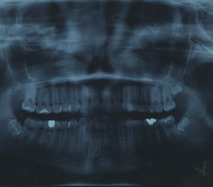 Leczenie interdyscyplinarne (chirurgiczno-ortodontyczne) zębiaka zestawnego związanego z zatrzymanym stałym siekaczem... Ryc. 2.