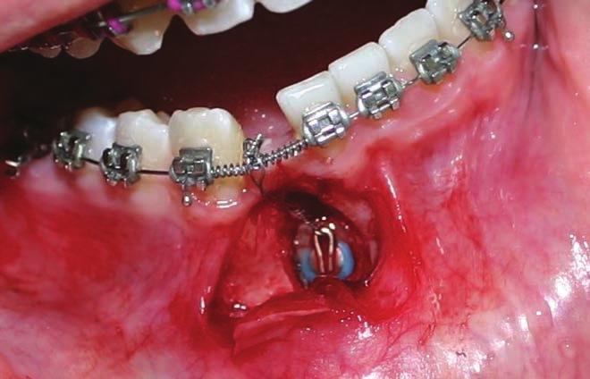 odsłonięcie zęba zatrzymanego i przyklejenie zaczepu ortodontycznego z wyprowadzeniem ligatury metalowej (ryc. 5).