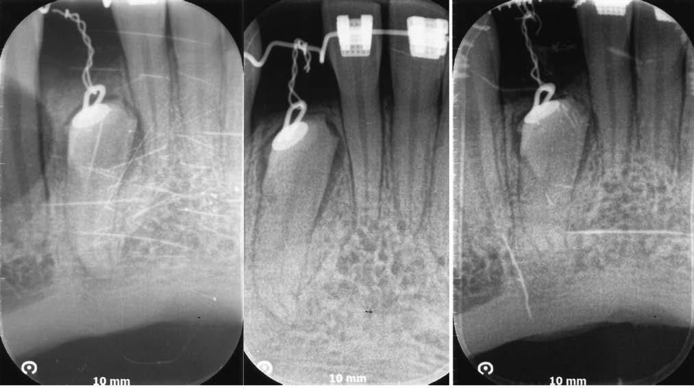 Diana Karolak, Joanna Lange i trzecim zdjęciu (17. i 22. miesiąc od rozpoczęcia leczenia) zaobserwowano progresję wyrzynania zęba zatrzymanego (ryc. 6a-c).