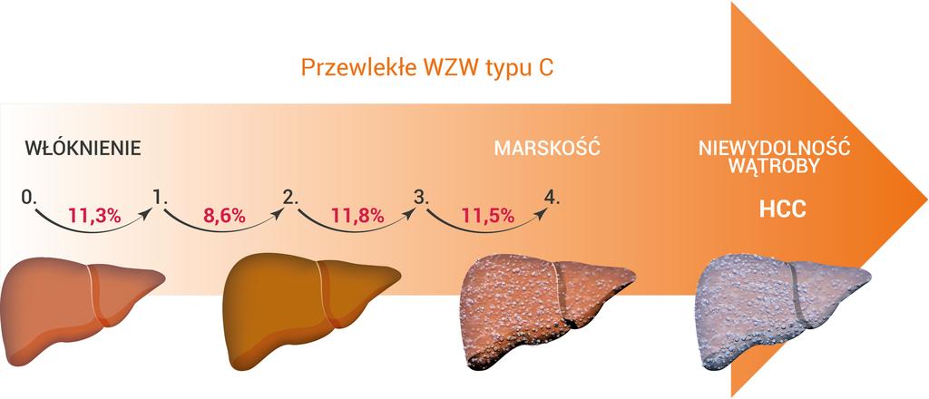 WZW TYPU C KONIECZNOŚĆ ZMIAN W ORGANIZACJI SYSTEMU OCHRONY ZDROWIA 39 Rysunek 4. Roczne prawdopodobieństwo przejścia do kolejnych etapów włóknienia wątroby u pacjentów z WZW typu C [68] Tabela 8.