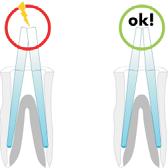 Wkład protetyczny Prosthetic Over Post Uniwersalne wkłady przeznaczone są do odbudowy zębów z brakującą lub bardzo zniszczoną koroną zęba.