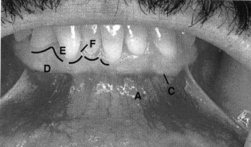 zębodołu D śluzowa dziąsła wolnego E bruzda dziąsłowa F brzeg dziąsła wolnego G