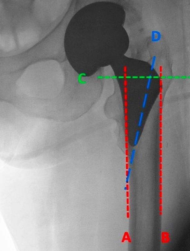 Figure 3 Radiological determination of endoprosthesis Proxima stem position in marrow cavity of proximal stump of femur using authors own method Valgus position.