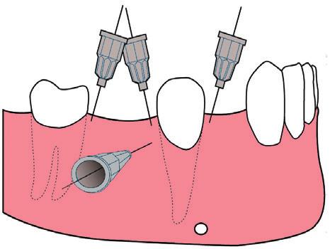Perforacja powinna być wykonana dystalnie w żuchwie, szczególnie w przypadku zębów bez bez krążenia.