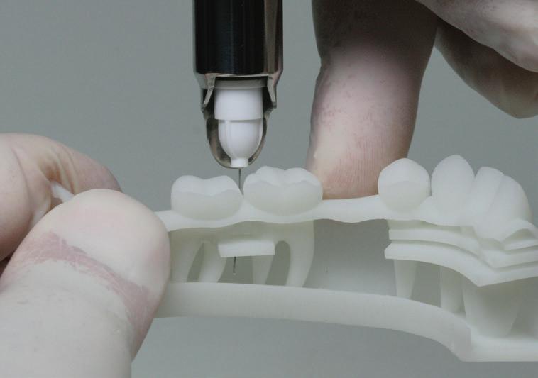 Dla komfortu pacjenta, należy unikać dotykania korony zęba z plastkową częścią igły podczas rotacji *