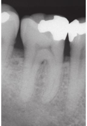 - Brak krążenia w jednym z korzeni zęba. W tym przypadku wykonaj znieczulenie Osteocentral dystalnie lub pomiędzy korzeniami zębów.