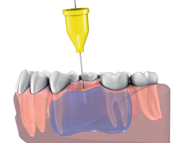 ZNIECZULENIA OSTEOCENTRAL/ TRANSKORTYLANE 2 rodzaje znieczulania dokostnego : znieczulenie osteocentral czy znieczulenie transkortykalne Obecność przegrody w miejscu iniekcji?