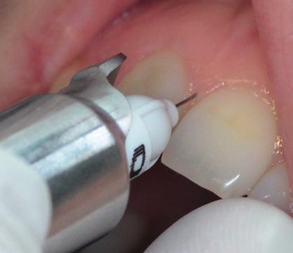 igłę. Upewnij się, iż ochraniacz wargowy nie będzie blokował pracy igły przez kontakt z sąsiednimi zębami (2).