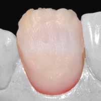 Nakłada się je na sieczną część zęba, np MM light, MM salmon.