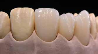 Uzupełnienie należy następnie umieścić na podstawce typu plaster miodu i wypalić zgodnie z parametrami dla napalania pierwszej dentyny/brzegu siecznego (patrz parametry napalania strona 65).