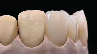Napalanie drugiej dentyny/brzegu siecznego Opracować uzupełnienie i dokładnie oczyścić. Do czyszczenia należy użyć kąpieli ultradźwiękowej lub wytwornicy pary.
