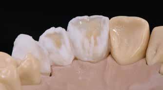 Następnie uzupełnienie należy dokładnie odsączyć, a brakujące obszary uzupełnić masami dentyny i brzegu siecznego.