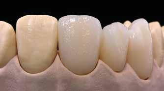 Uzupełnienie należy następnie umieścić na podstawce typu plaster miodu i wypalić zgodnie z parametrami napalania drugiej dentyny/brzegu siecznego (patrz