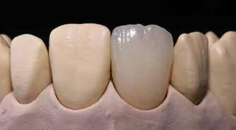 Uzupełnienie należy następnie umieścić na podstawce typu plaster miodu i wypalić zgodnie z parametrami dla napalania pierwszej dentyny/brzegu siecznego (patrz parametry