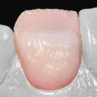 lub ZirLiner można zwiększyć jasność w obszarze dentyny, tak aby uzyskać wrażenie wychodzenia z głębi.