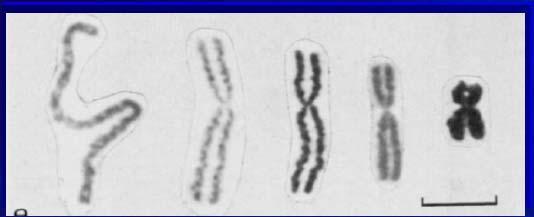 Chromosomy n różnym etpie kondenscji Chromosomy człowiek rwione srerem.