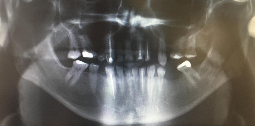 K. Mordarski i inni Ryc. 1. Zdjęcie ortopantomograficzne pacjenta. protetyczne zgodnie z drugą koncepcją zostało opisane w artykule Pietruskiego i Pietruskiej.