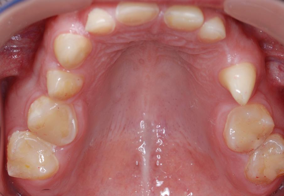 5. Przed leczeniem zdjęcie powierzchni okluzyjnych zębów żuchwy.