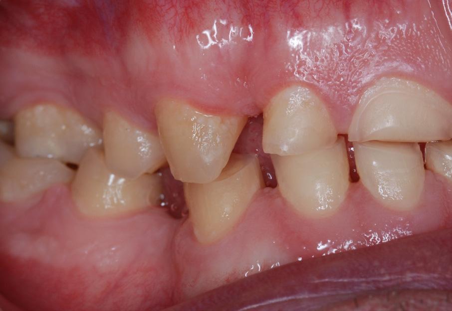 zaburzenie linii środkowej górnego i dolnego łuku zębowego,