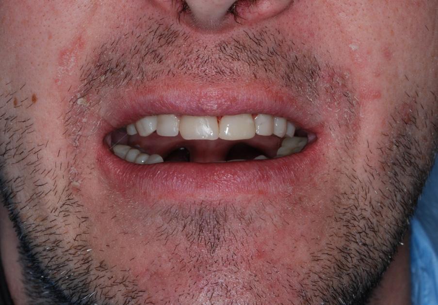 Erozja zębów możliwości leczenia protetycznego na podstawie... Ryc. 10. Efekt leczenia widok en face. Ryc. 11.