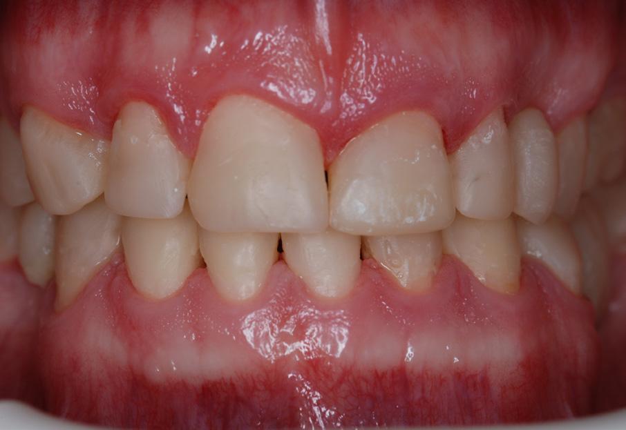 Po leczeniu zdjęcie powierzchni okluzyjnych zębów szczęki. kompozytowym.