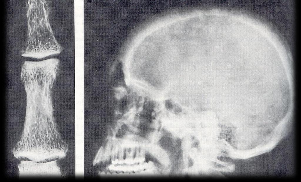 Osteoporoza w przebiegu pierwotnej nadczynności