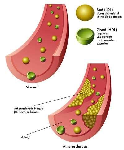 Cholesterol dobry cholesterol HDL jest transportowany do wątroby i tam przerabiany na potrzebne związki (np. hormony).