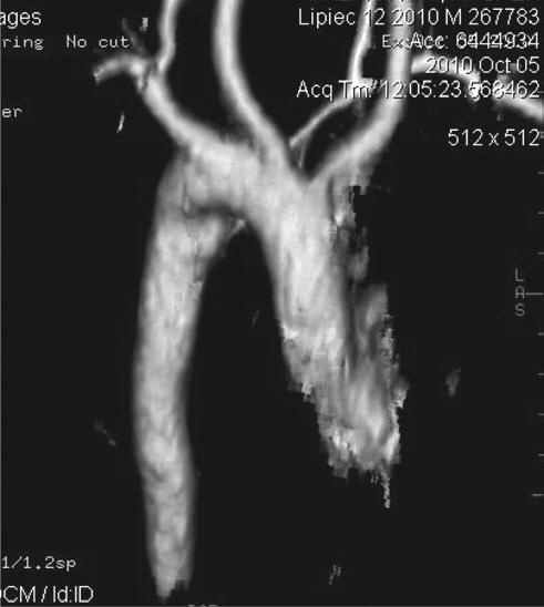 Wpływ wady łuku aorty na sposób i wyniki leczenia pacjentów z wrodzoną niedrożnością przełyku Ryc. 2. Rekonstrukcja angio-tk: prawostronny łuk aorty z lewą błądzącą tętnicą podobojczykową Ryc. 3.