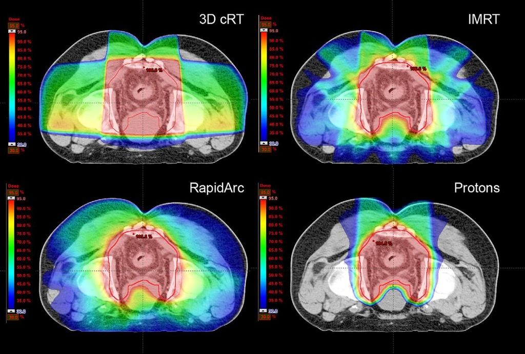 1. Podstawy radioterapii protonowej Zalety radioterapii protonowej - Rozkład dawki - Weryfikacja - Radiobiologia - Niskie