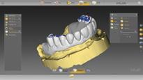 0: Modele Aby uzyskać większą elastyczność, ustawienie zębów i suprastrukturę implantologiczną można zaprojektować osobno.