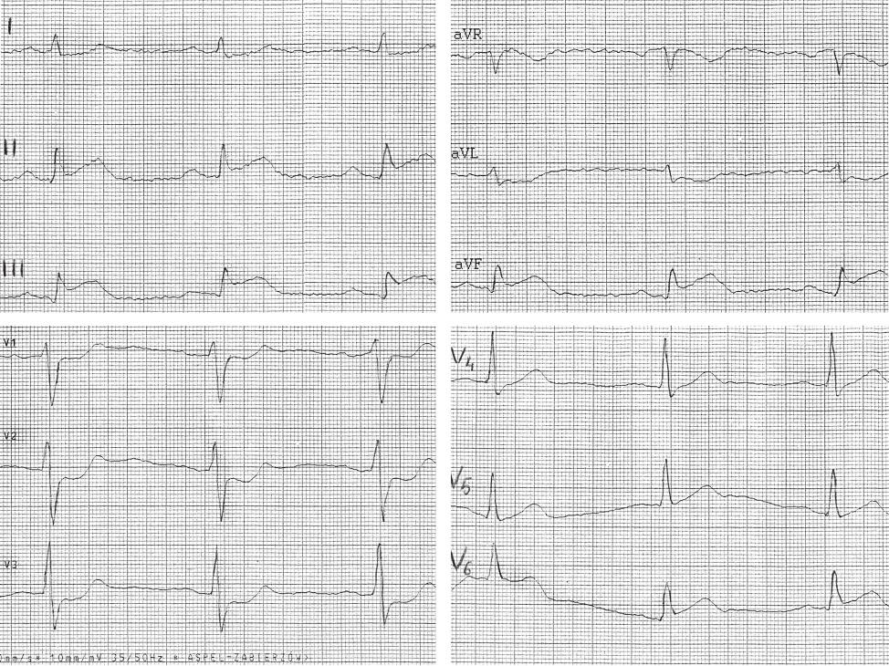 ST-segment elevation in lead V1 proximal right coronary artery occlusion Rycina 4.