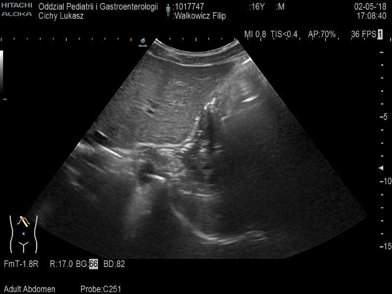 DIAGNOSTYKA ULTRASONOGRAFIA jjj W porównaniu z 24-godzinną ph-metrią