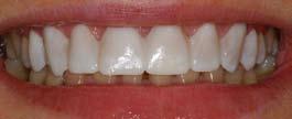 Gdy decyzja zapadnie, wycisk w zaakceptowanej przez pacjenta formie trafia do laboratorium, a zęby pacjenta są preparowane, czyli przygotowywane do założenia licówek.