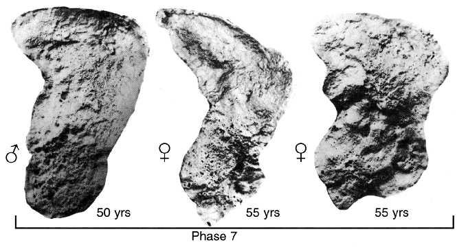 Phase 7: Age 50-59; dense irregular
