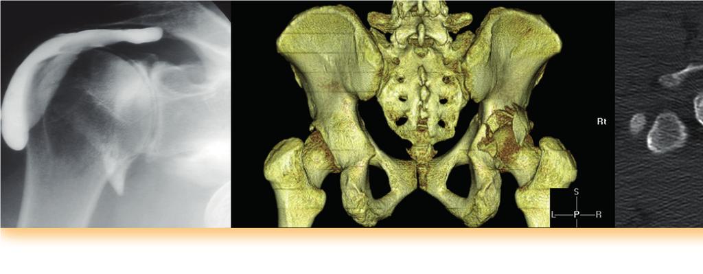 rozdział 4 Diagnostyka radiologiczna w urazach Radiologiczne metody obrazowania W ocenie urazów układu mięśniowo-szkieletowego znajdują zastosowanie następujące metody obrazowania: 1.