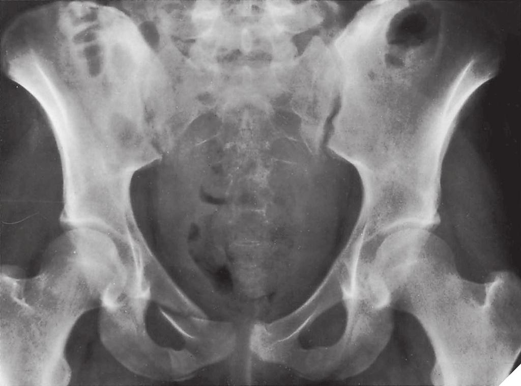 ROZDZIŁ 4 Diagnostyka radiologiczna w urazach 61