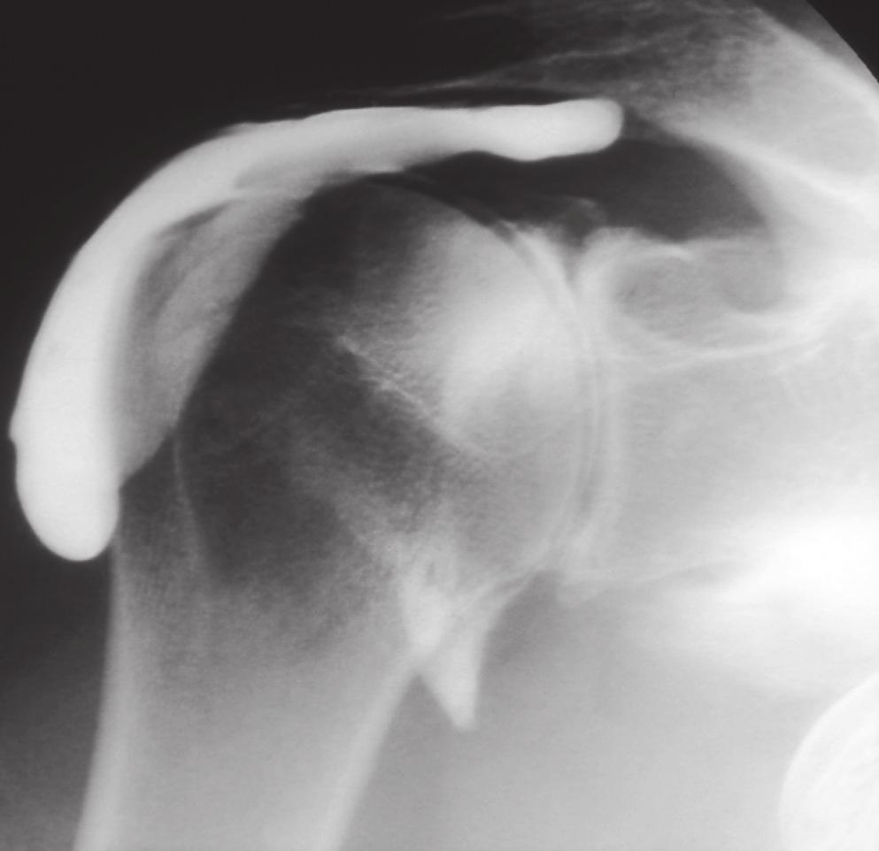 ROZDZIŁ 4 Diagnostyka radiologiczna w urazach 63 RYCIN 4.12 Rozerwanie pierścienia rotatorów.