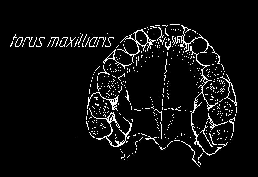 20.b torus maxillaris wał kostny, bądź