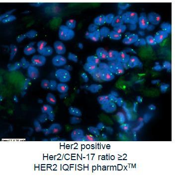 HER2 badanie immunohistochemiczne oraz fluorescencyjna hybrydyzacja in situ (ISH, FISH) są zalecanymi metodami oceny statusu Her2, w celu kwalifikacji do leczenia anty - Her2 badanie fluorescencyjnej