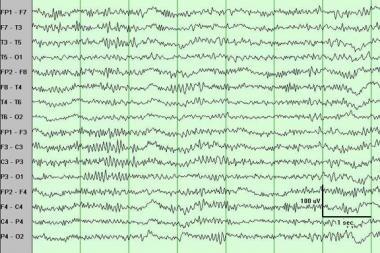 Beta (13-30Hz) (desynchronizacja zapisu) beta 1/2/3 aktywacja korowa wszelkiego