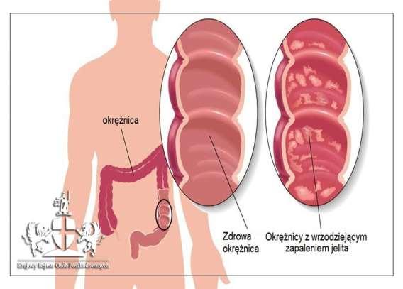 Jakie są sposoby leczenia nieswoistych zapaleń jelit? Leczenie zależy od fazy choroby oraz od nasilenia objawów i wieku pacjenta.