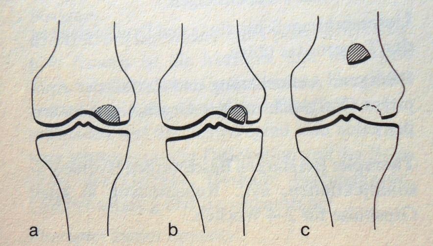 Oddzielająca martwica chrzęstno-kostna (Osteochondrosis dissecans) Martwica obszaru