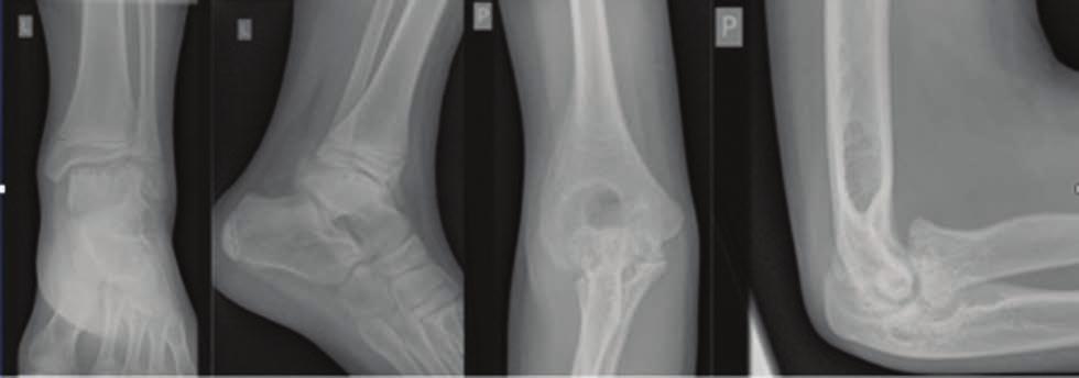 Diagnostyka radiologiczna artropatii hemofilowej Tab.. Skala Petterssona.