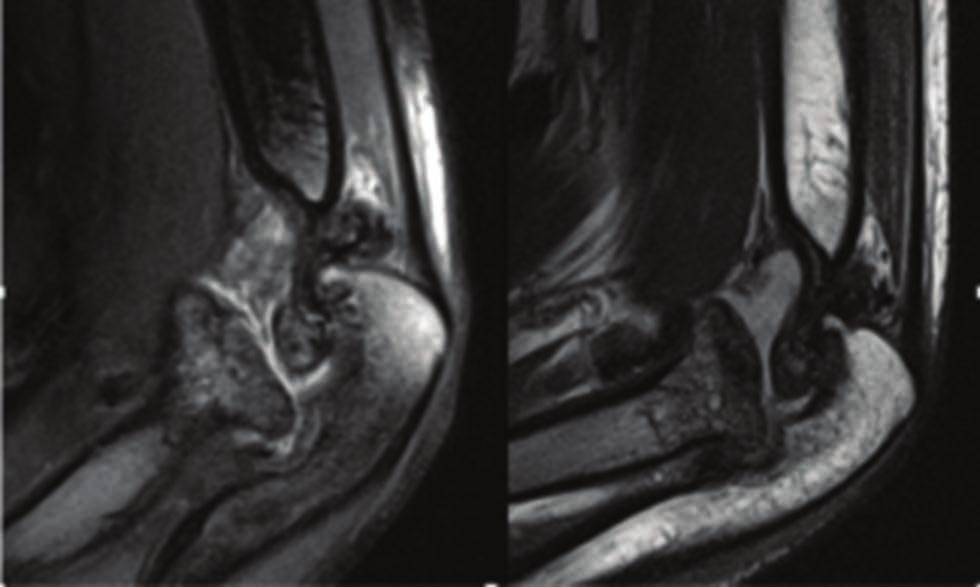 Diagnostyka radiologiczna artropatii hemofilowej Ryc. 4.
