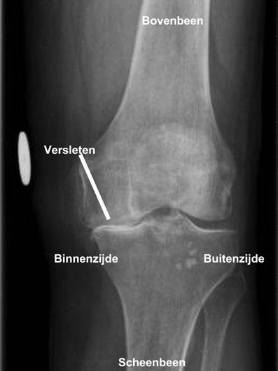 Slijtage Als de kwaliteit van het kraakbeen vermindert, spreken we van slijtage (artrose). Dit kan in de hele knie of in 1 helft voorkomen.