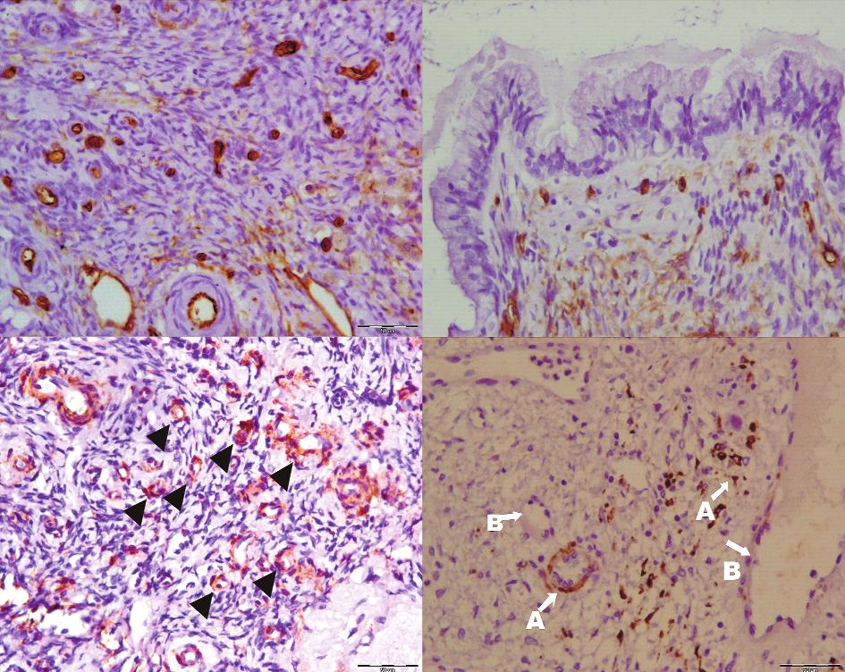 a b c d Ryc. 1. Mikronaczynia (górny panel) i otaczające pericyty (dolny panel) w raku jajnika. Powiększenie 200x a. Ekspresja CD34 w komórkach śródbłonka w raku surowiczym jajnika b.